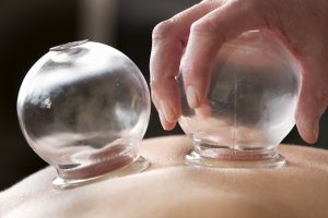 Chinese traditional medicine, cupping therapy